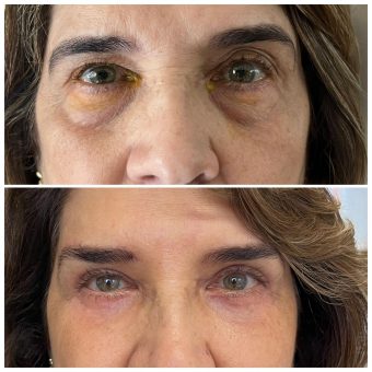 Método Olhar 4K melhor curso procedimentos estéticos para região periocular
